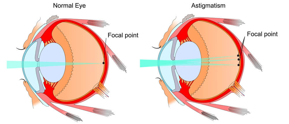 Eye and Vision Conditions