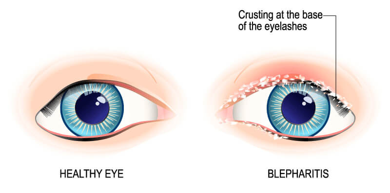 Blepheritis chart