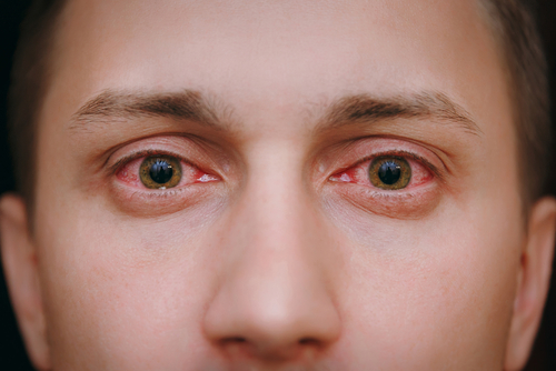 Conjunctivitis