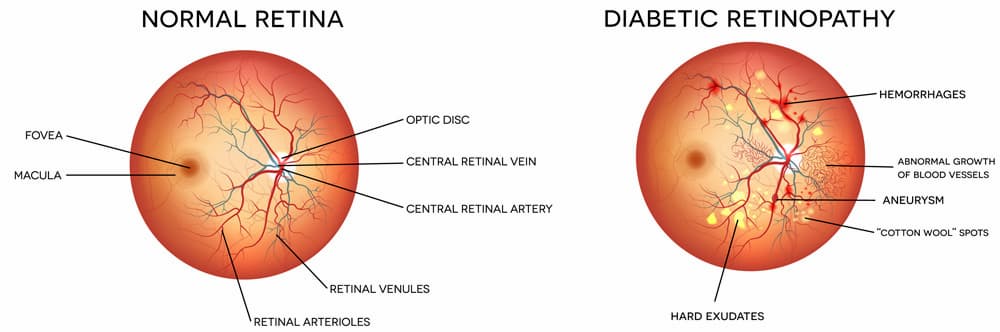 Diabetic Retinopathy Chart