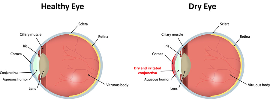 Dry Eyes chart