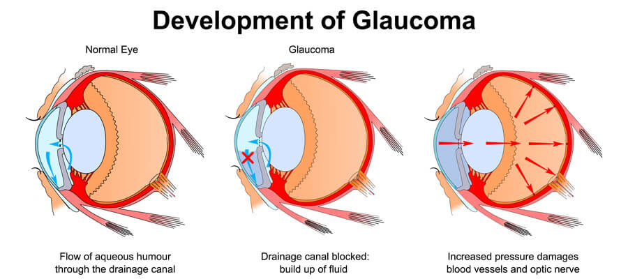 Glaucoma Development
