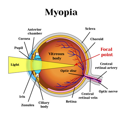 Myopia