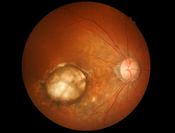 Macular Degeneration